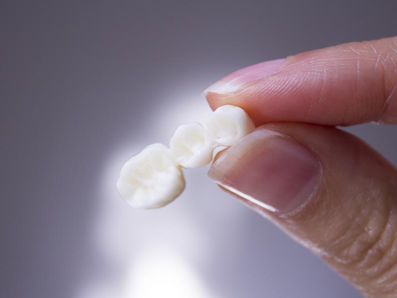 dental bridge