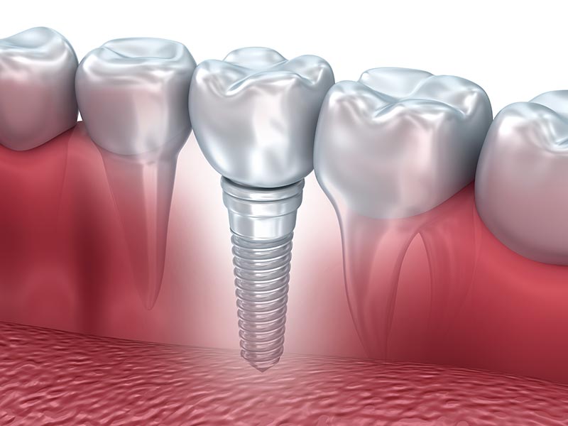 Dental Implants illustration