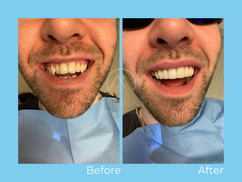Composite Bonding Before & After