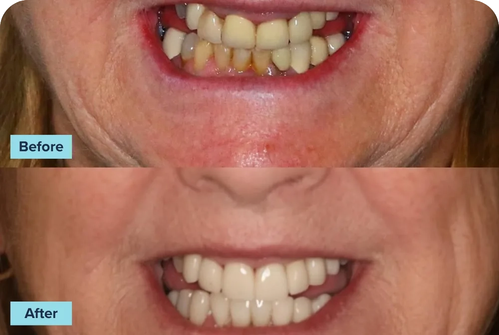 BeforeAfterVeneersFirst (1)