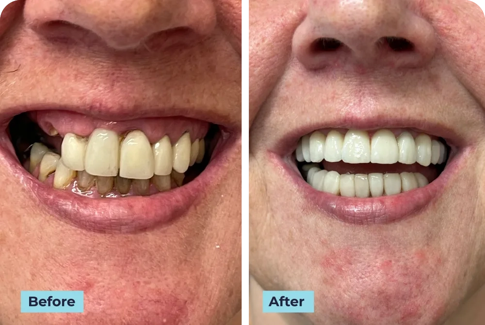 Upper_implants_image (2)