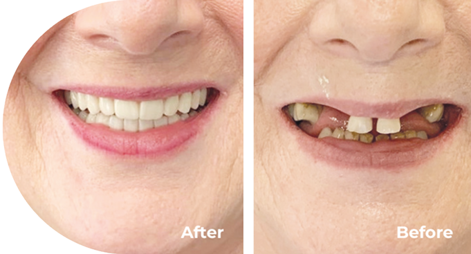 Comparison of a person's smile before and after dental treatment, showing significant improvement in teeth appearance.