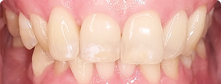 Close-up of a teen’s teeth and gums showing straighter alignment after clear aligner treatment.