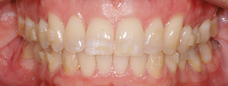 A close-up smile shows straighter upper and lower teeth with improved alignment after clear aligner treatment.